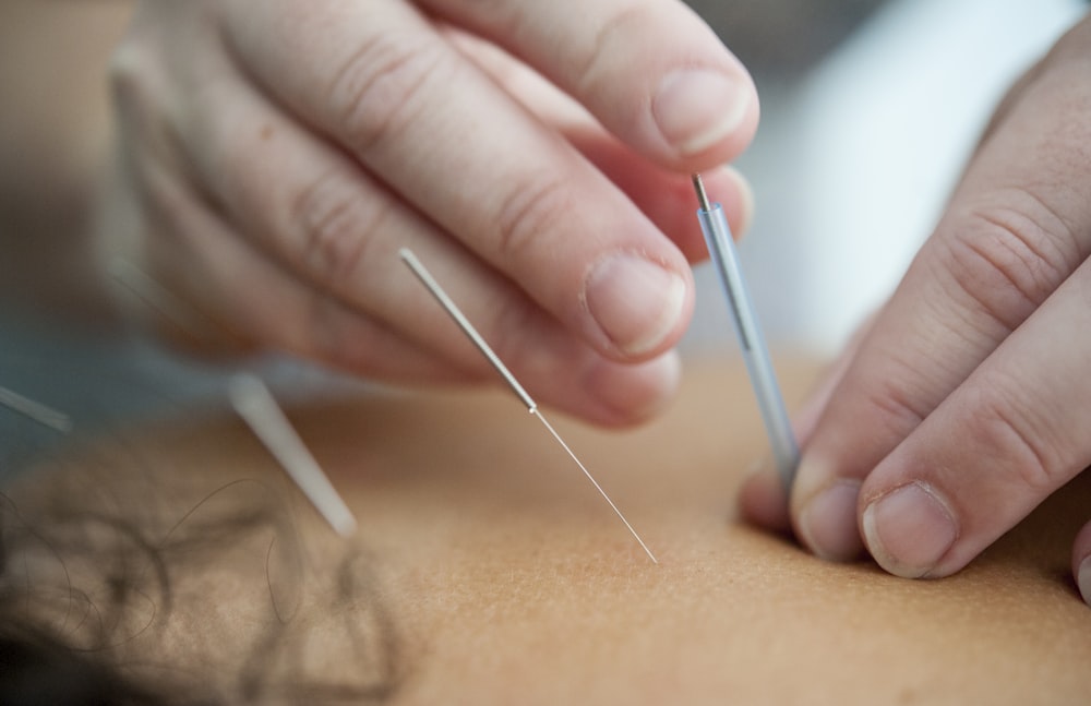 Buying Acupuncture Needles Online