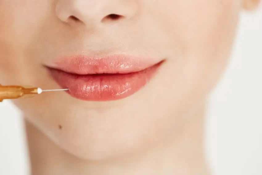 Lip Fillers Transform Aesthetic Journey