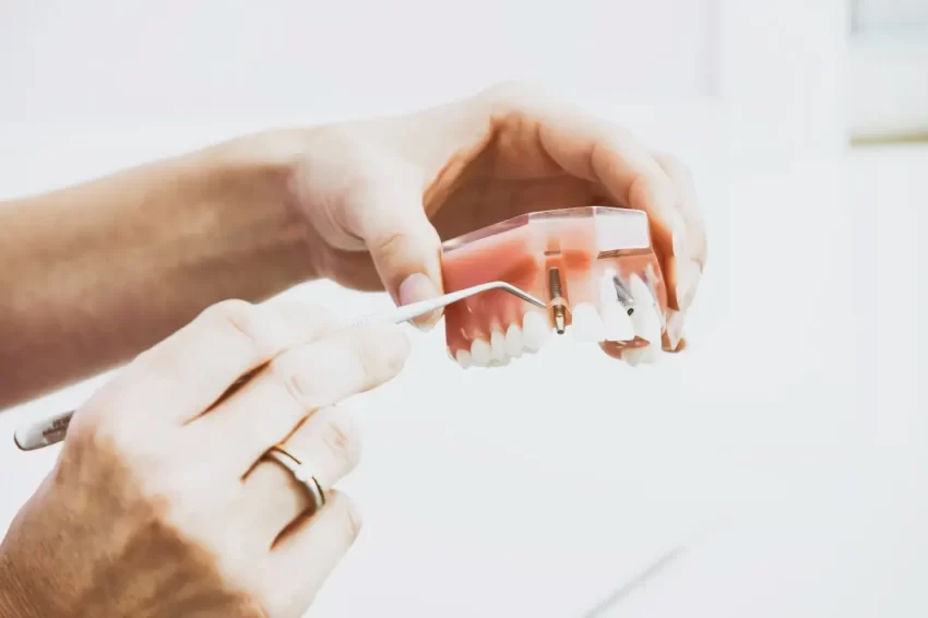 Considerations of Dental Implants